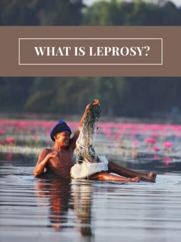 An old man with leprosy holding fishnet in his hands.